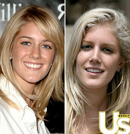 heidi montag surgery before and after. Heidi Montag is Cha$ing Beauty